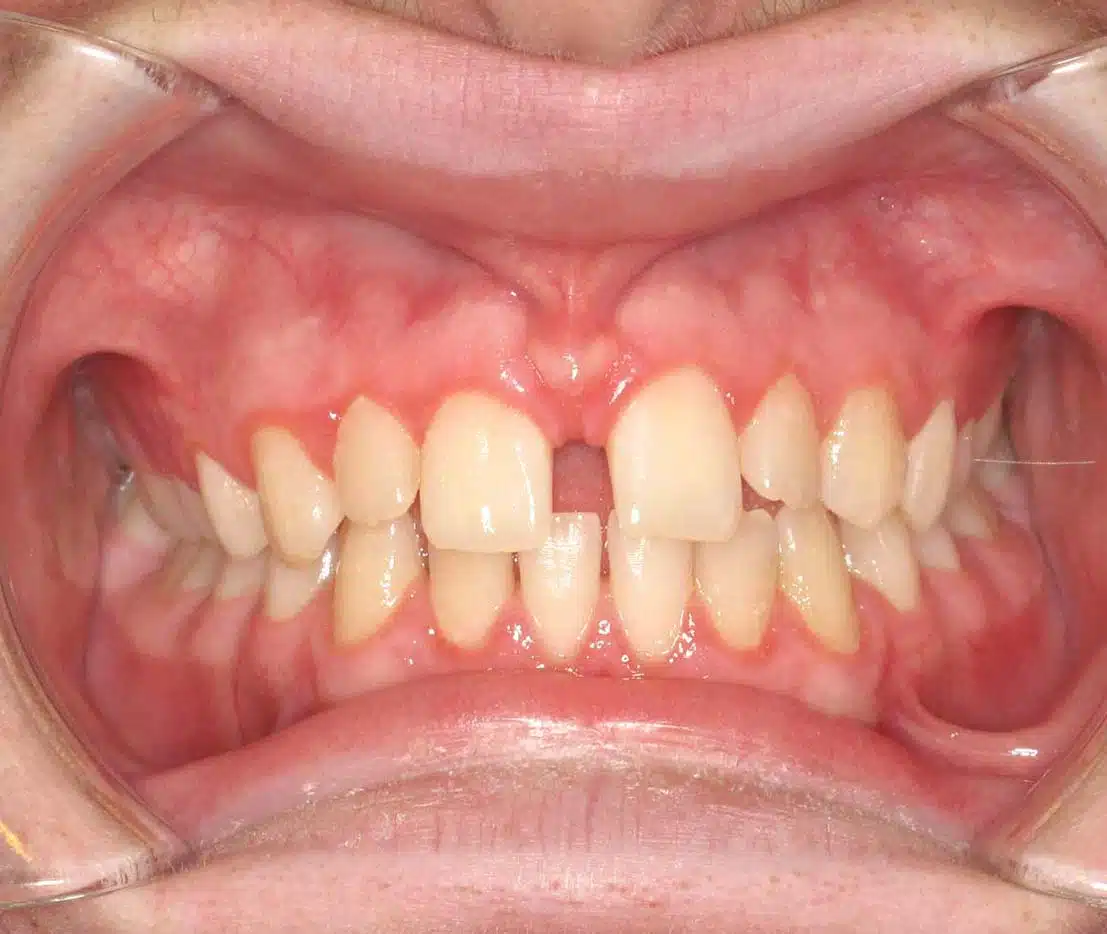 Orthodontic transformation at Windermere Orthodontics