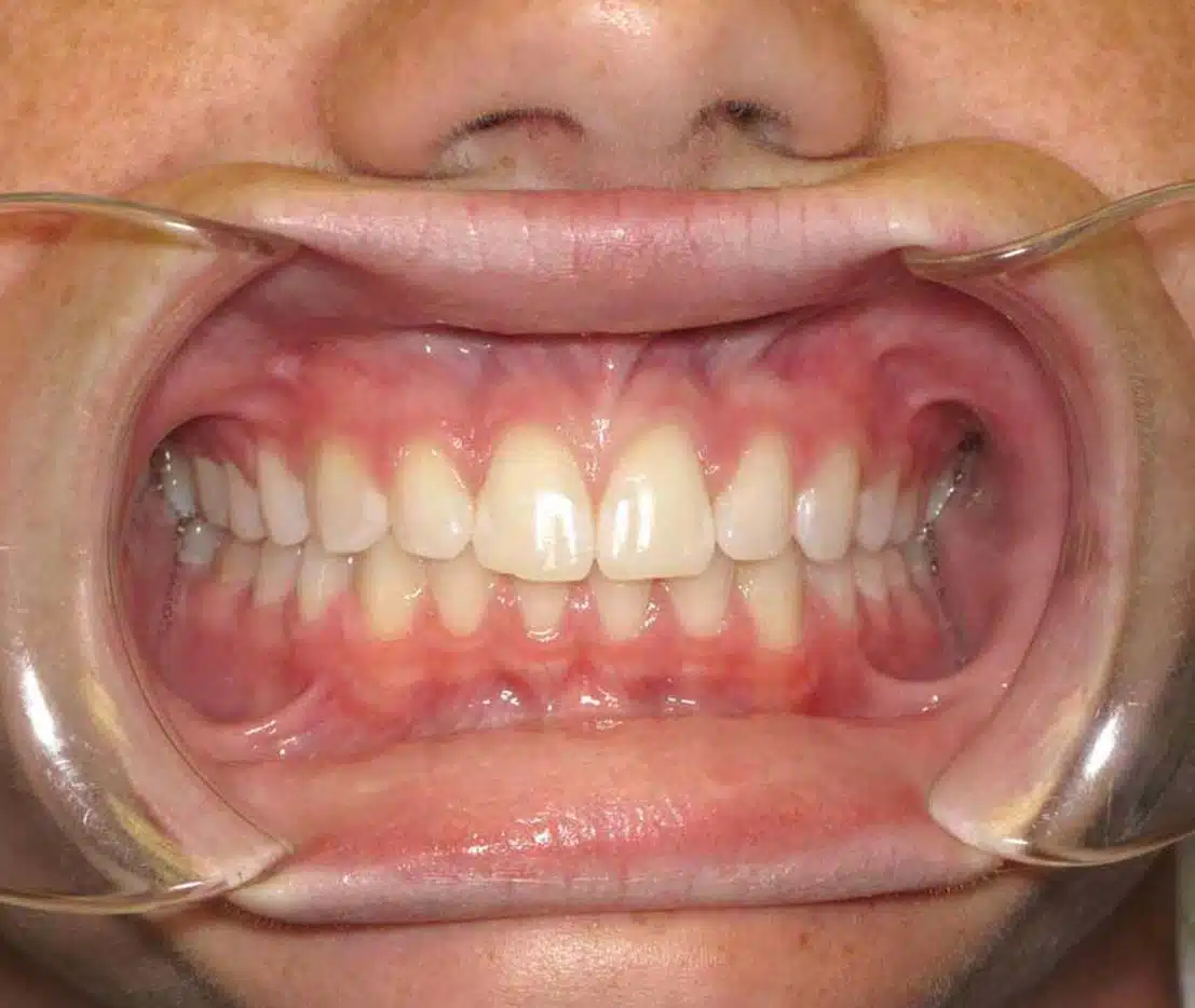 Patient transformation with clear braces at Windermere Orthodontics