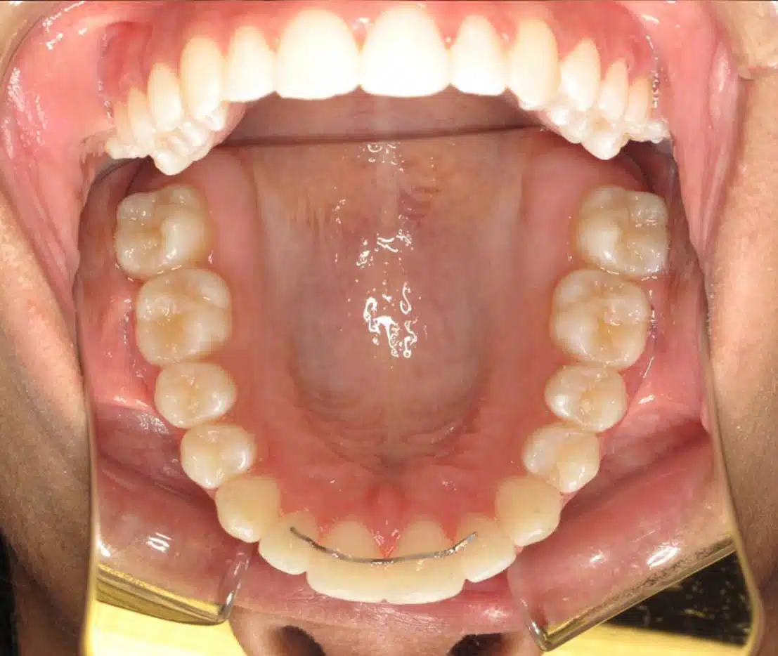 Orthodontic treatment progress photos in Suwanee and Cumming