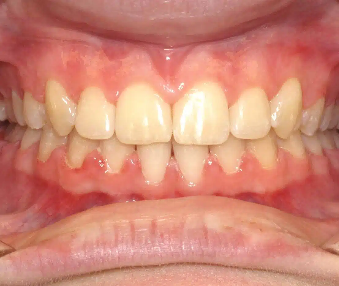 Orthodontic correction at Windermere Orthodontics