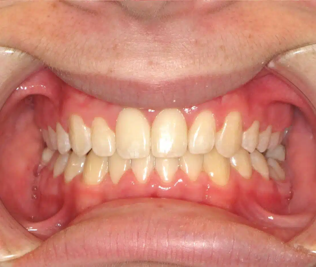 Clear aligner before and after at Windermere Orthodontics