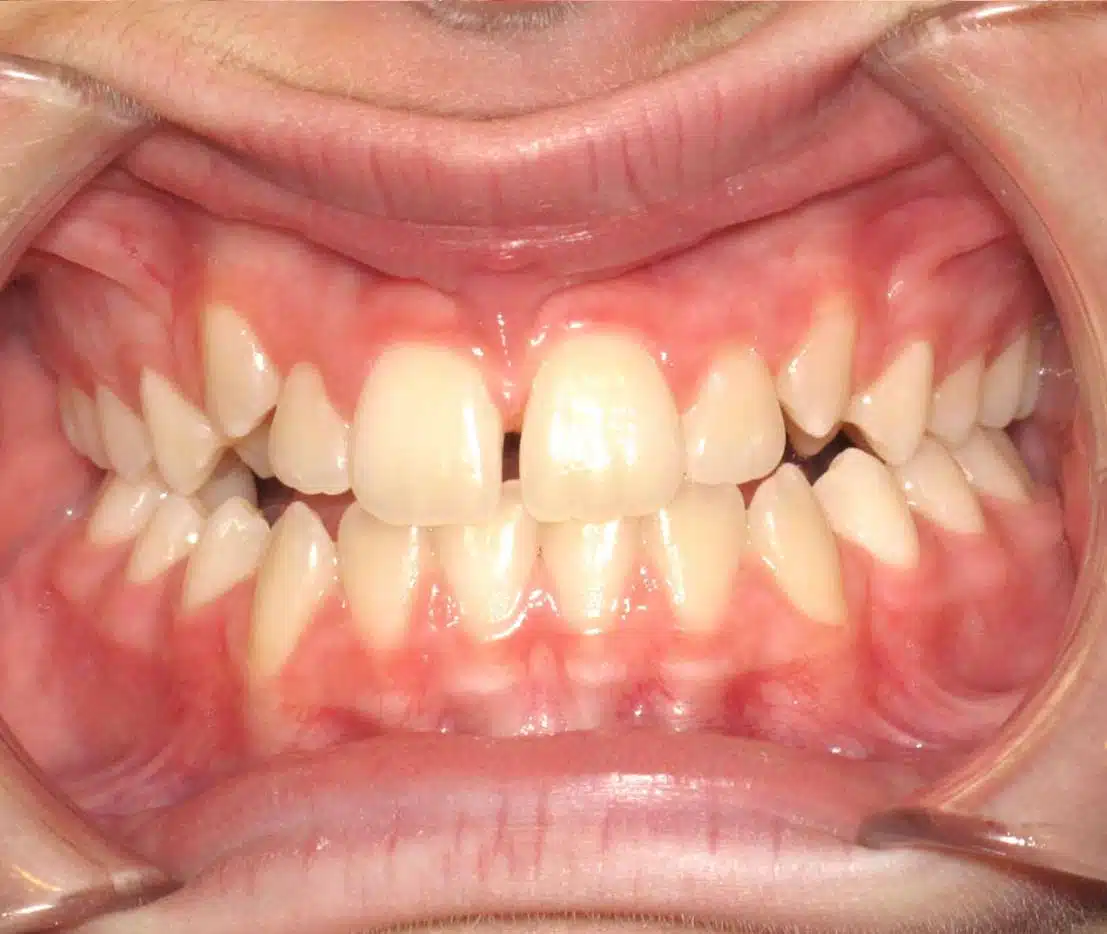 Teeth straightening progress at Windermere Orthodontics