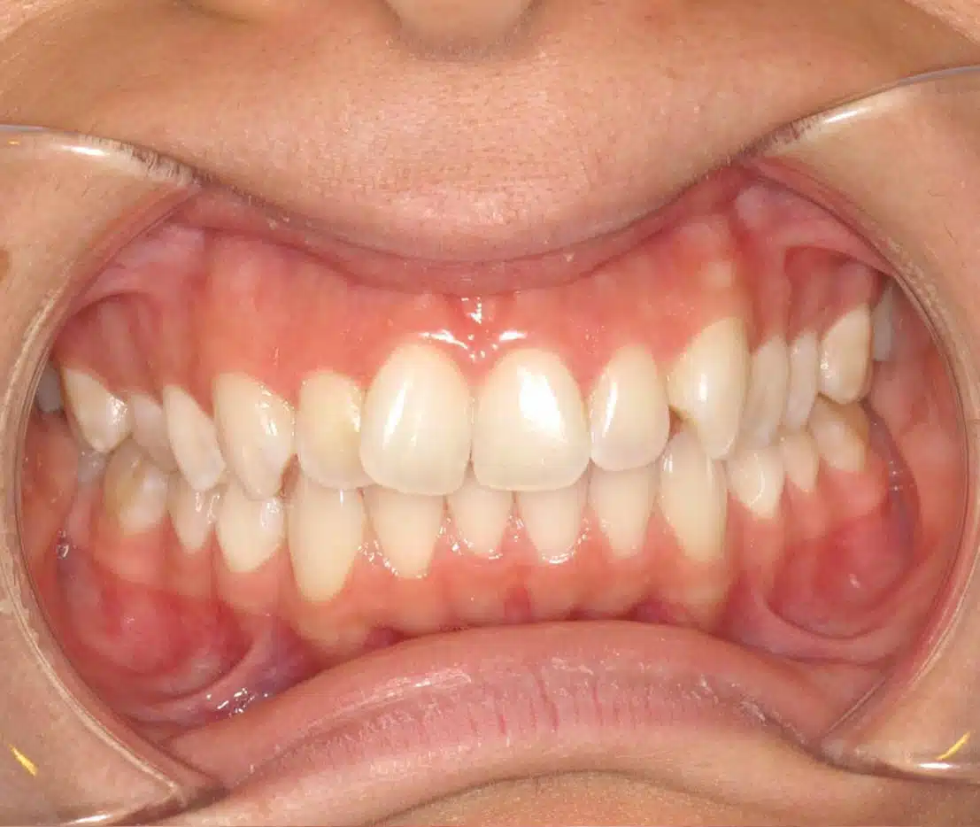 Smiling patient after orthodontic treatment at Windermere Orthodontics