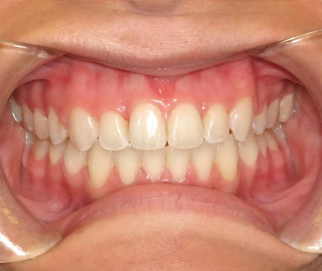Orthodontic progress photos at Windermere Orthodontics