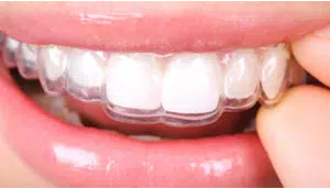 Custom clear retainers at Windermere Orthodontics