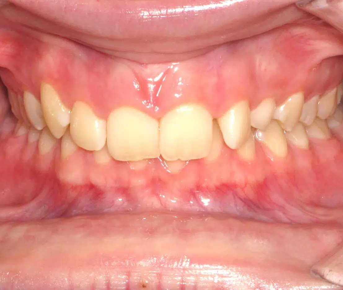 Teeth alignment before and after at Windermere Orthodontics