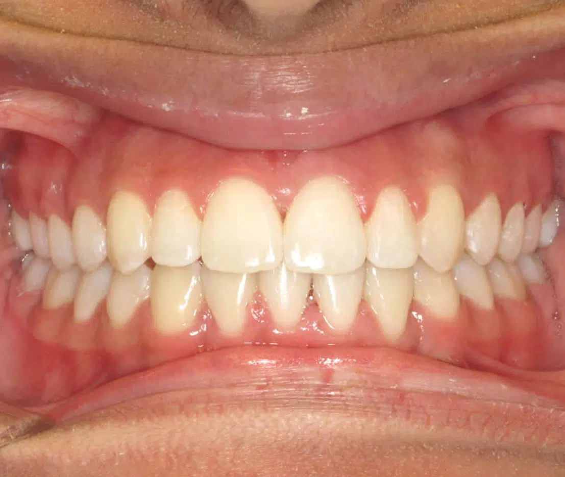 Before and after traditional braces at Windermere Orthodontics