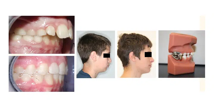 mara-appliance-before-after-suwanee-orthodontist-windermere