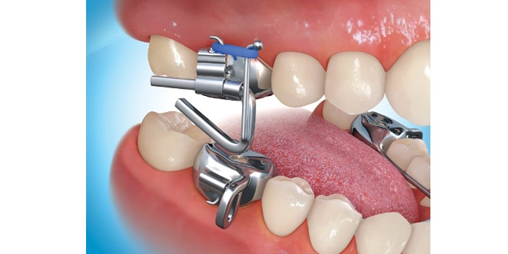 The Mara Appliance | Windermere Orthodontics - Cumming ...