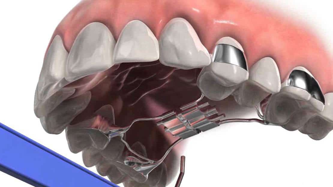 Orthodontic Expander: More Benefits Than Esthetics