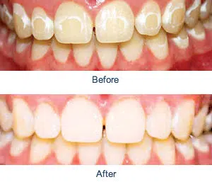 sports smile transformation before and after photos