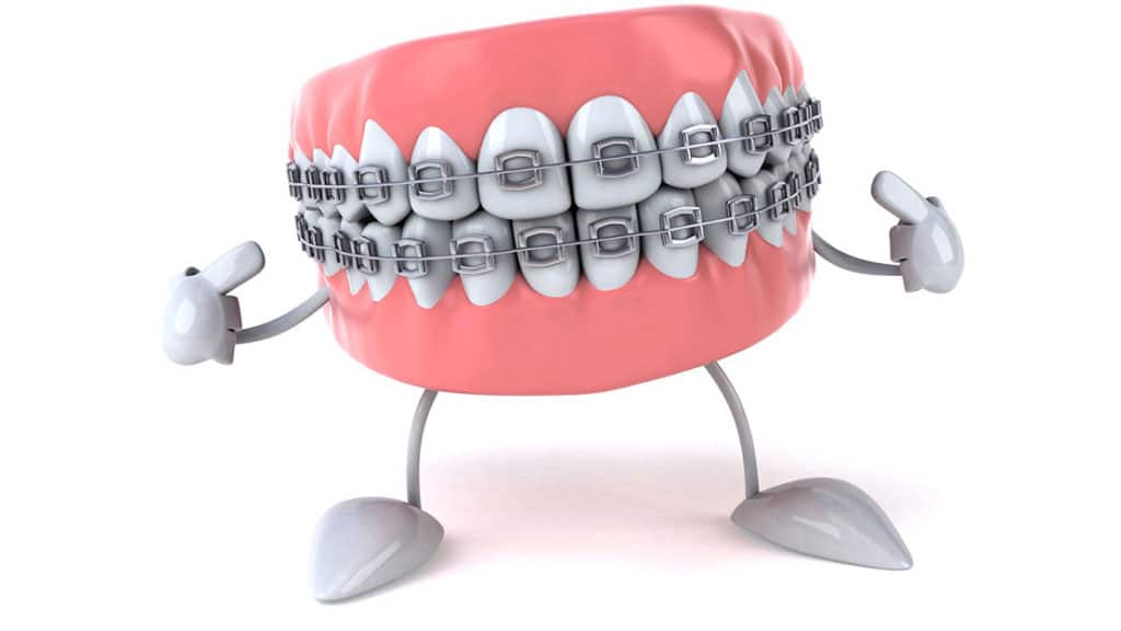 Important Things to Consider Before Getting Braces Orthodontist