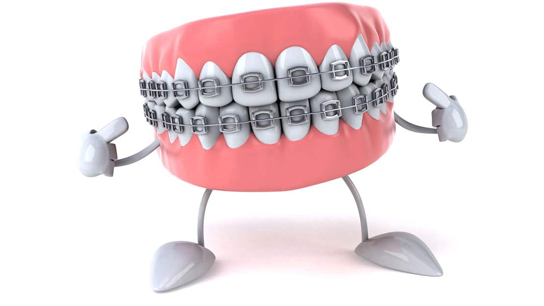 Important Things to Consider Before Getting Braces Orthodontist