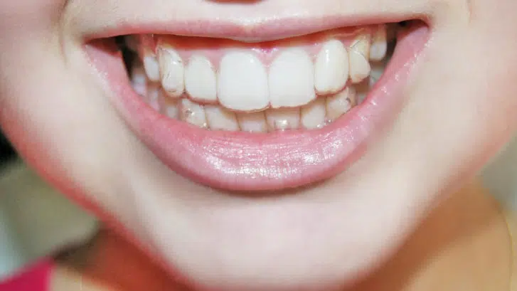 https://windermereorthodontics.com/wp-content/uploads/2019/01/suwanee-orthodontist-cumming-brookhaven-Windermere-Orthodontics-why-you-may-need-invisalign-attachments-727x409.jpg.webp