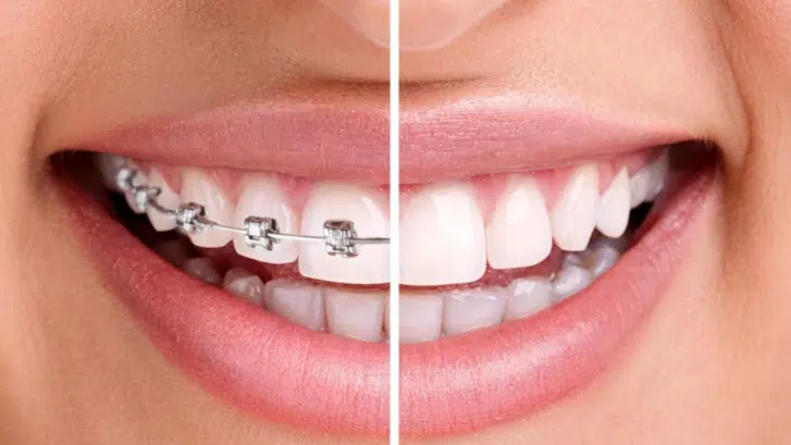 Making the Choice Between Braces and Invisalign: Factors to Consider