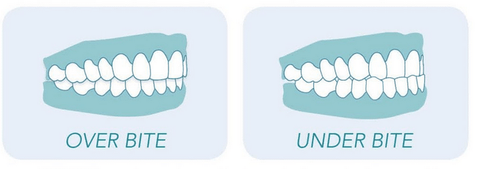 Overbite vs. Underbite: Differences, Causes, and Treatment Options