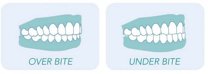 Overbite vs. Underbite: Differences, Causes, and Treatment Options